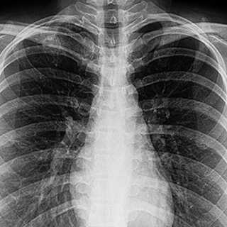 Outbreak of lung injury associated with e-cigarette use, or vaping